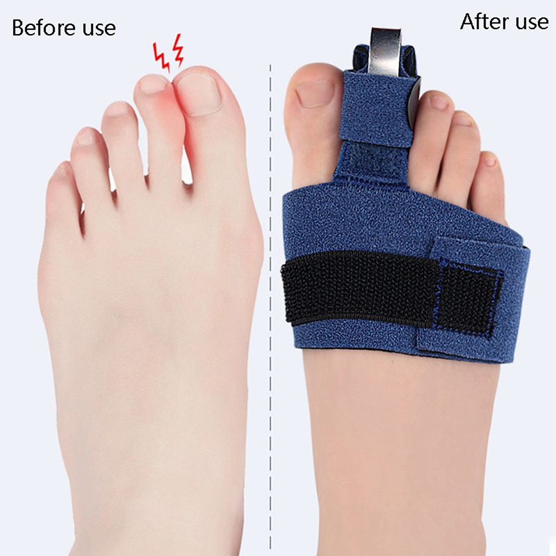 1個入りつま先矯正器、骨折矯正器、足の骨矯正装具、親指調整器 - Ankle Brace Sock のレビューと価格